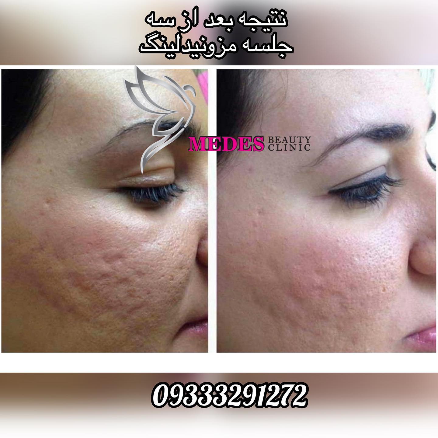 گالری مزونیدلینگ